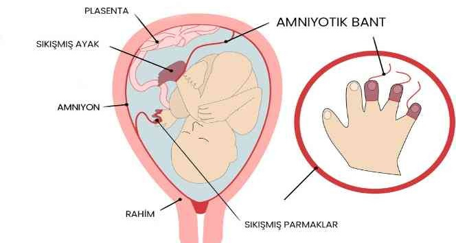 Amniyotik bant sendromu olan bebekler anne karnında ameliyat ile tedavi edilebiliyor