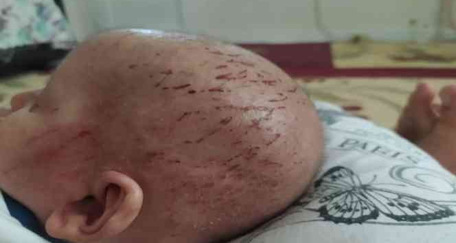 ’Balık pulu’ hastalığıyla yaşayan çocuğun hayatı kabusa döndü