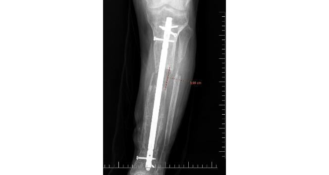 İş kazası geçiren hastaya boy uzatma ameliyatı yapıldı