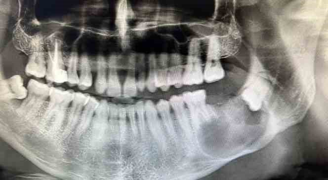 3D modelleme üzerinde test yapıldı, ardından hastaya uygulandı