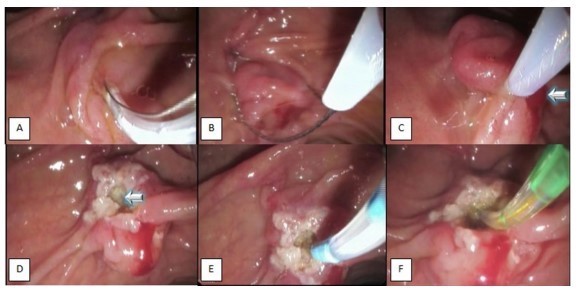 Gastroenteroloji kliniğinden bir ilk daha