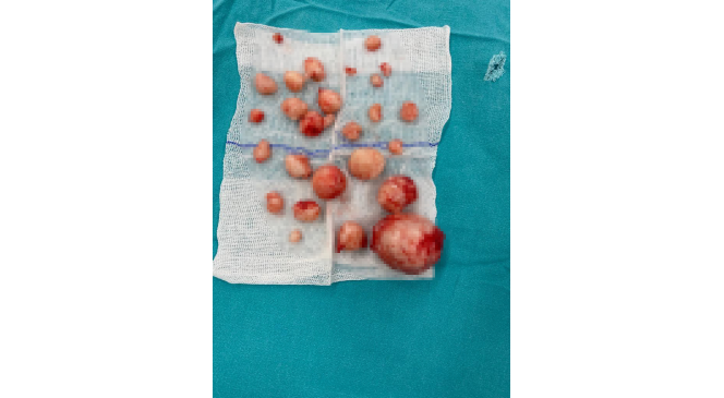 Diyarbakır&rsquo;da 40 yaşındaki kadının rahminden 26 adet miyom &ccedil;ıkartıldı
