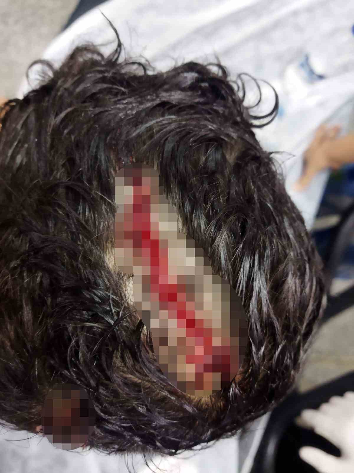 Köpeğin saldırısına uğrayan çocuğun kafasında derin yaralar oluştu
