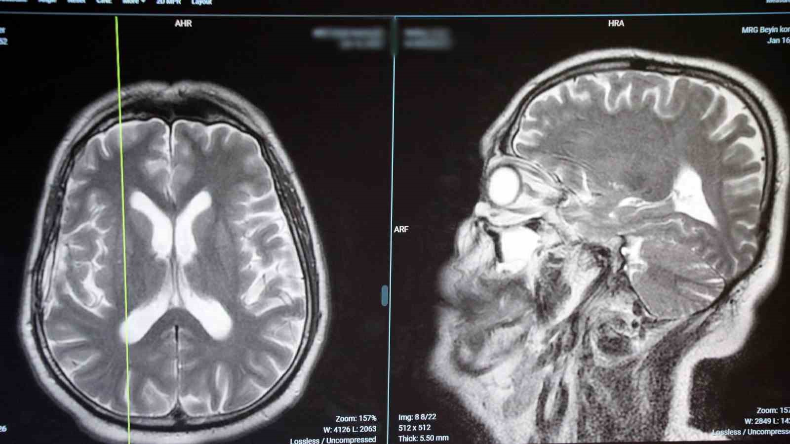 Beyin tümörlerinde zaman kaybı ölüme yol açıyor