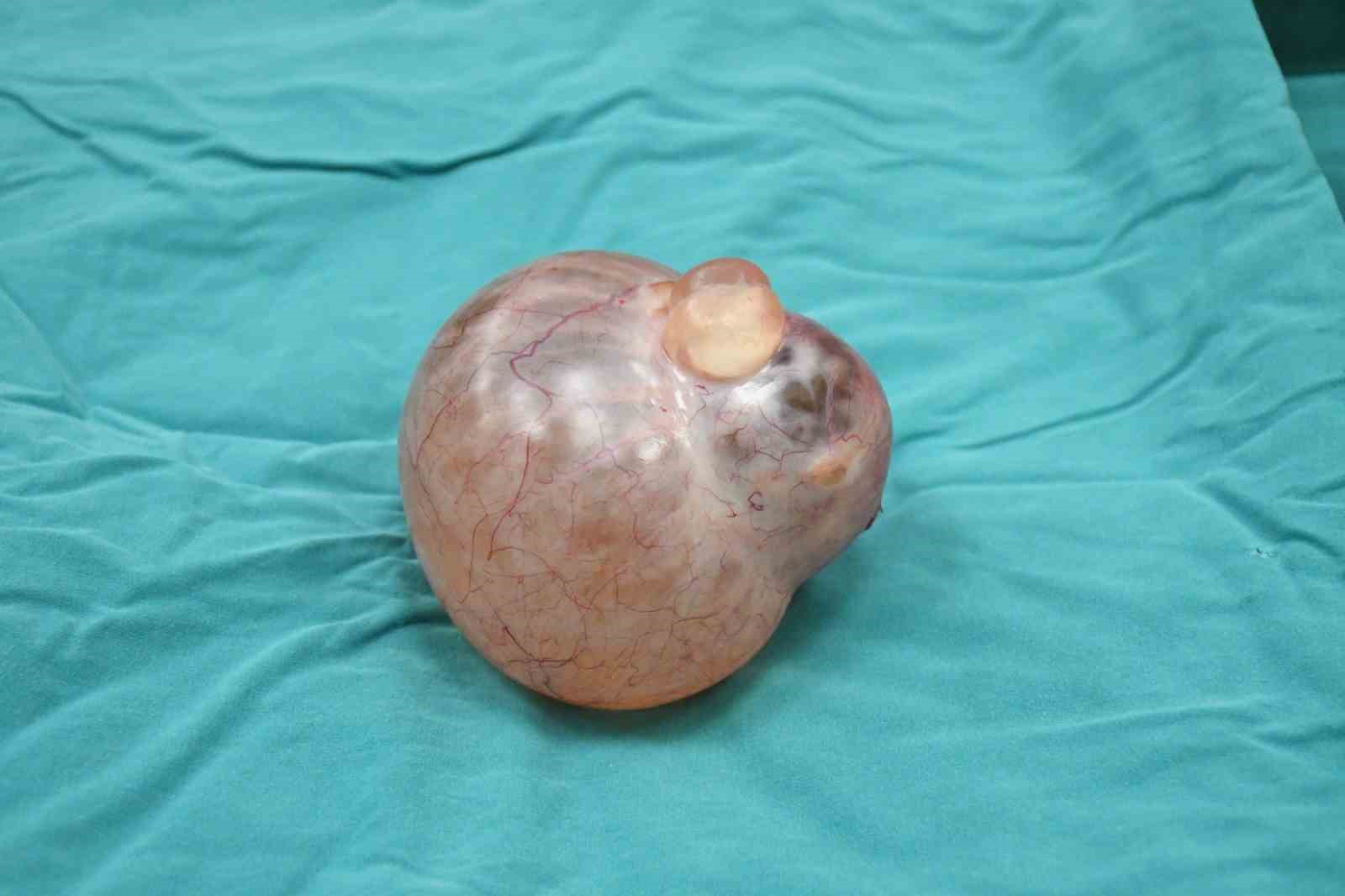 Yaşlı kadının karnından portakal b&uuml;y&uuml;kl&uuml;ğ&uuml;nde kitle &ccedil;ıkarıldı
