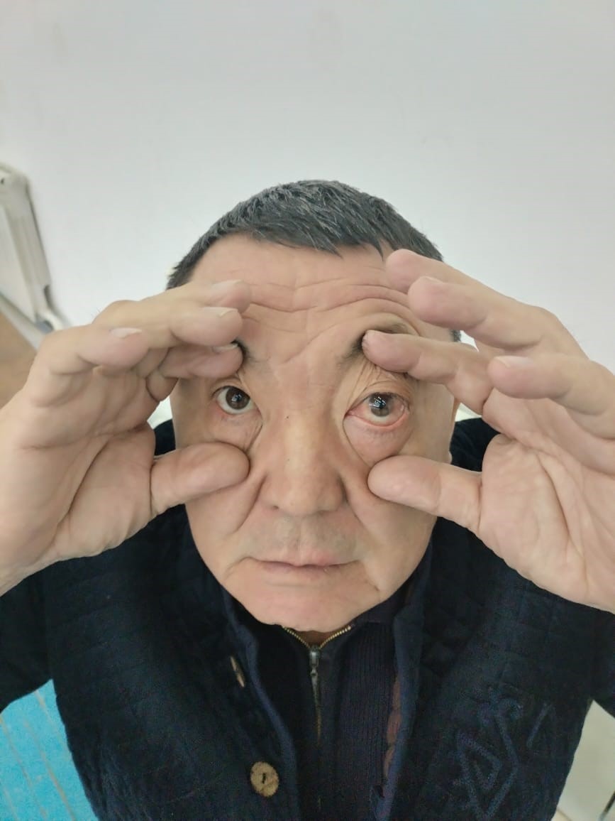 &Uuml;lkesinde &rsquo;g&ouml;z t&uuml;m&ouml;r&uuml;s&uuml;n&rsquo; denilen hasta, Antalya&rsquo;da 1,5 saate sağlığına kavuştu
