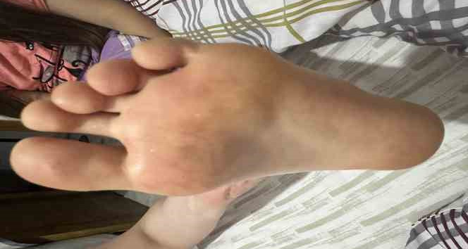 Çocuklarda artan el ayak ağız hastalığına dikkat: Uzmanlar tatilde ortak kullanılan alanlara karşı uyardı