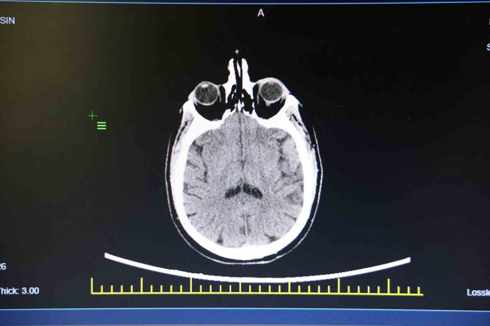 KBB Uzmanı Prof. Dr. Sakallıoğlu: "İşitme kaybının çok büyük bir kısmı tedavi edilebilmektedir"