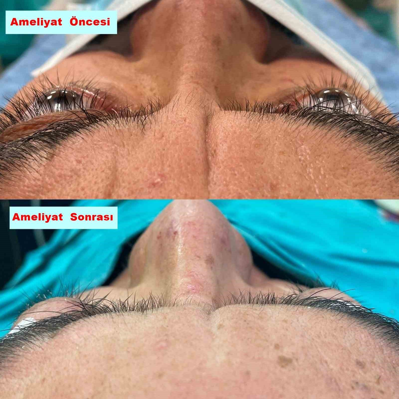 Muğla EAH hastanesinde sağlığına kavuştu
