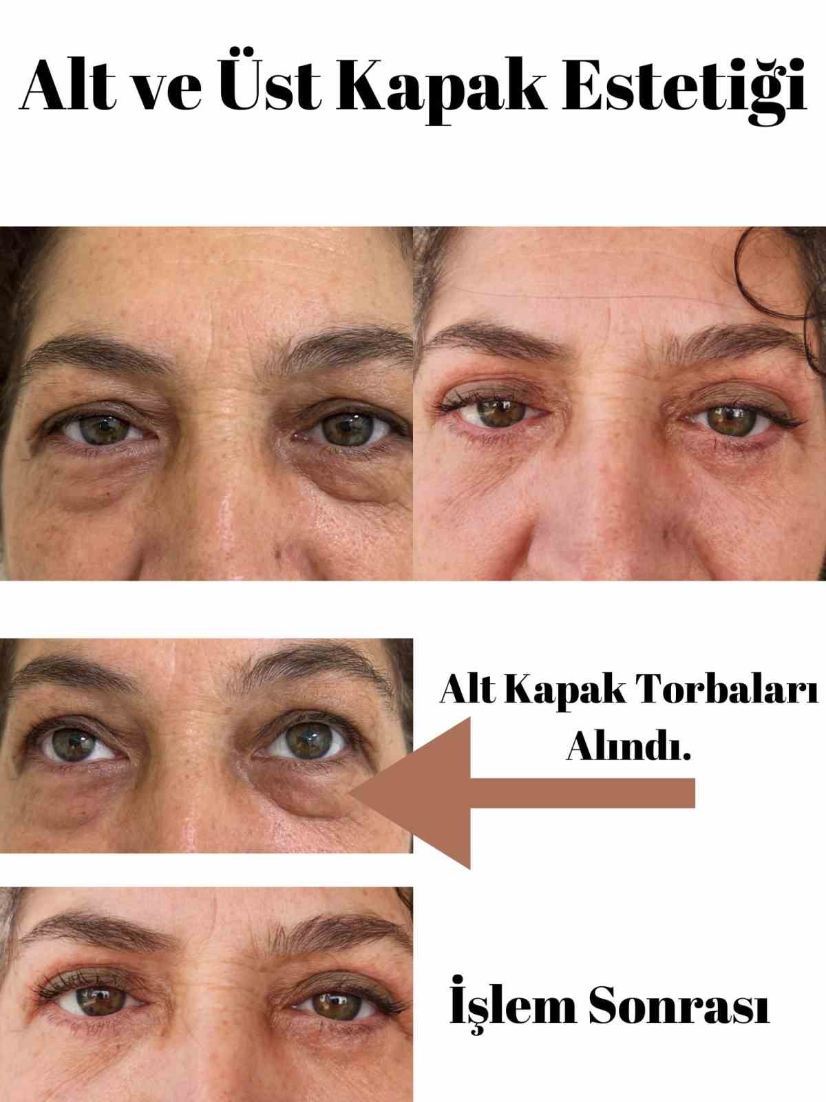 Elmalı Devlet Hastanesi’nde göz kapağı estetik ameliyatları başladı