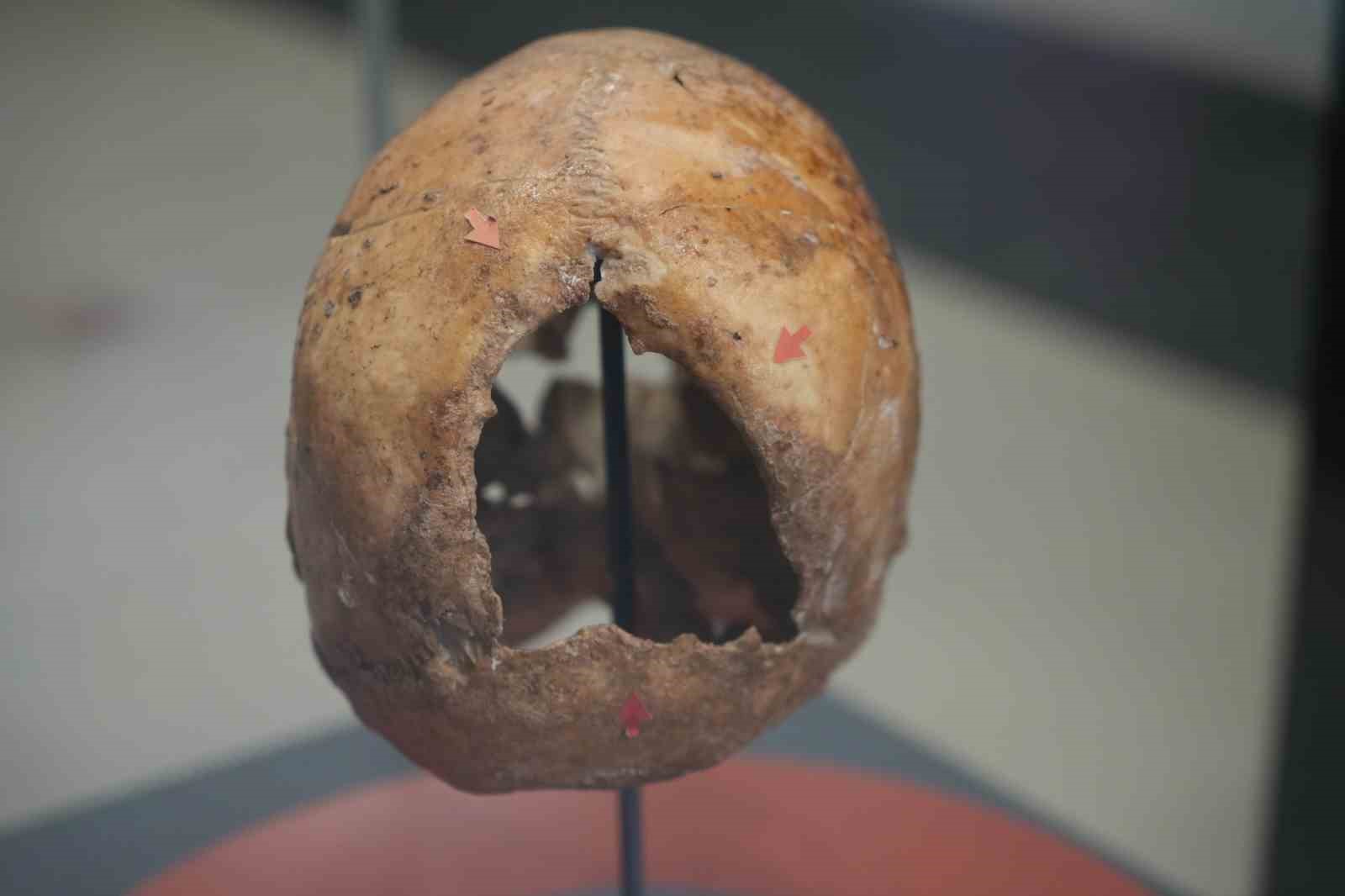 5 bin yıl önce ameliyat edilen kafatası ilgi çekiyor
