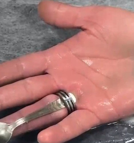 Parmağa sıkışan y&uuml;z&uuml;k kesilerek &ccedil;ıkarıldı
