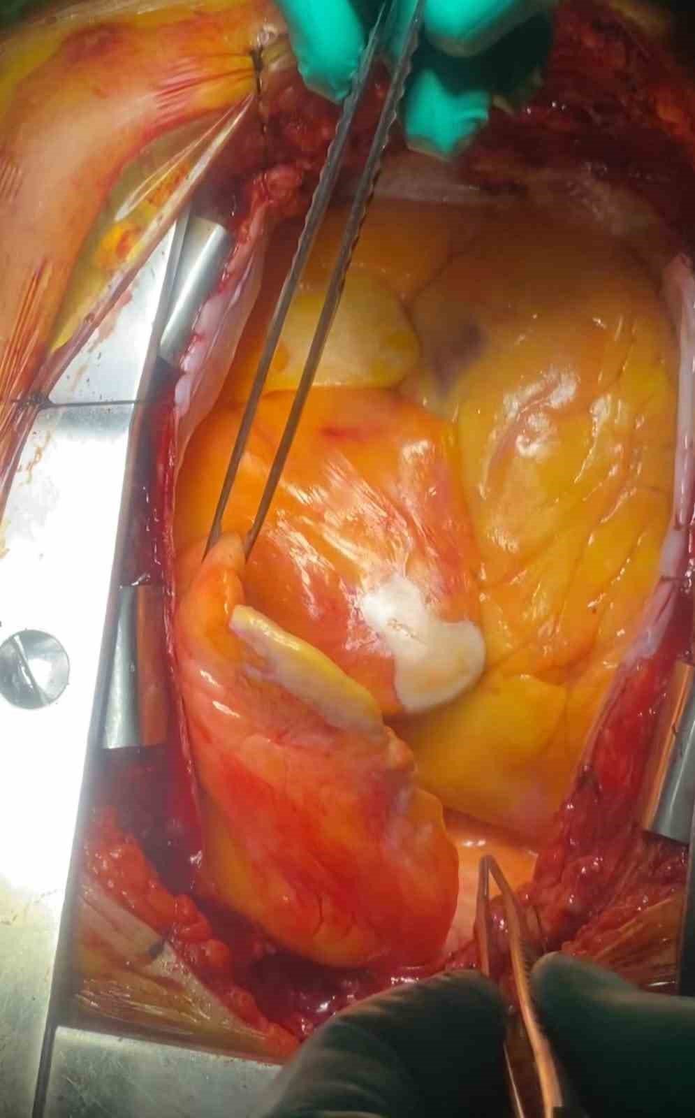 Kalpten beslenerek çevresini tamamen saran 1,1 kilogram yağ kitlesi görenleri hayrete düşürdü