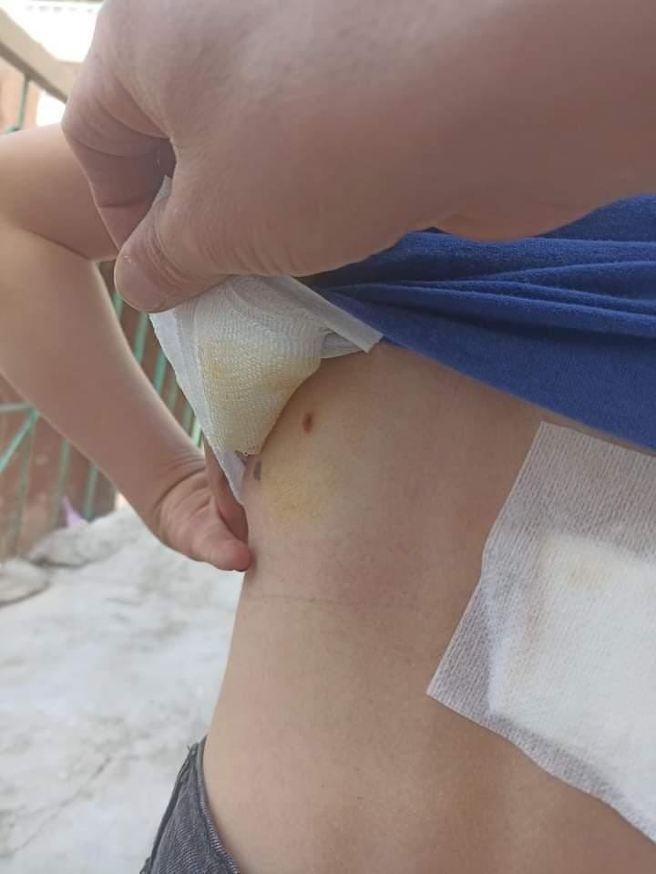 Diyarbakır’da 8 yaşındaki çocuk sokak köpeklerinin saldırısında yaralandı