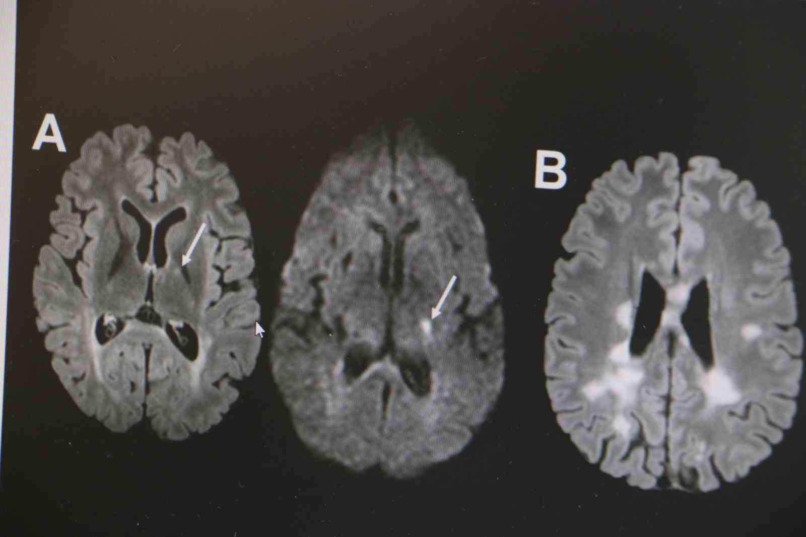 Nöroloji Uzmanı Dr. Demir: "MS hastalığında D vitamini oldukça önemlidir"