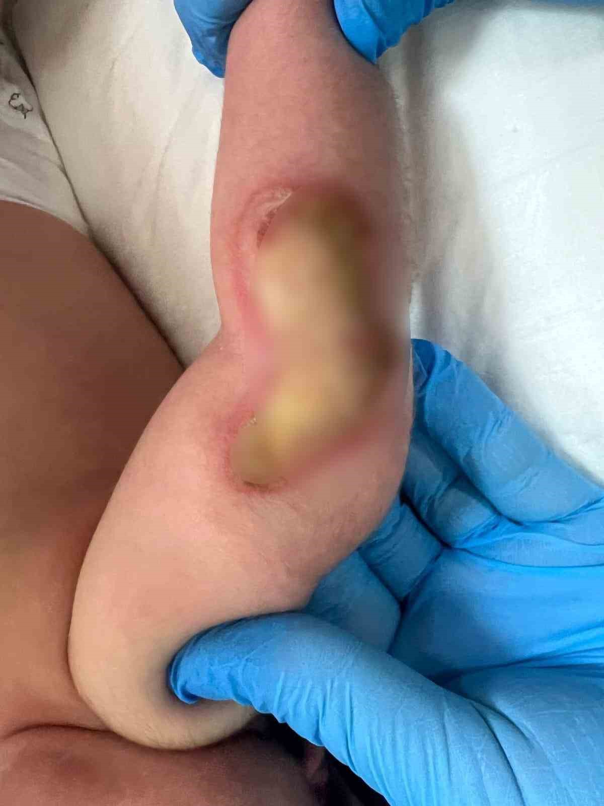 Kuv&ouml;ze alınan bebeğin kolu yandı
