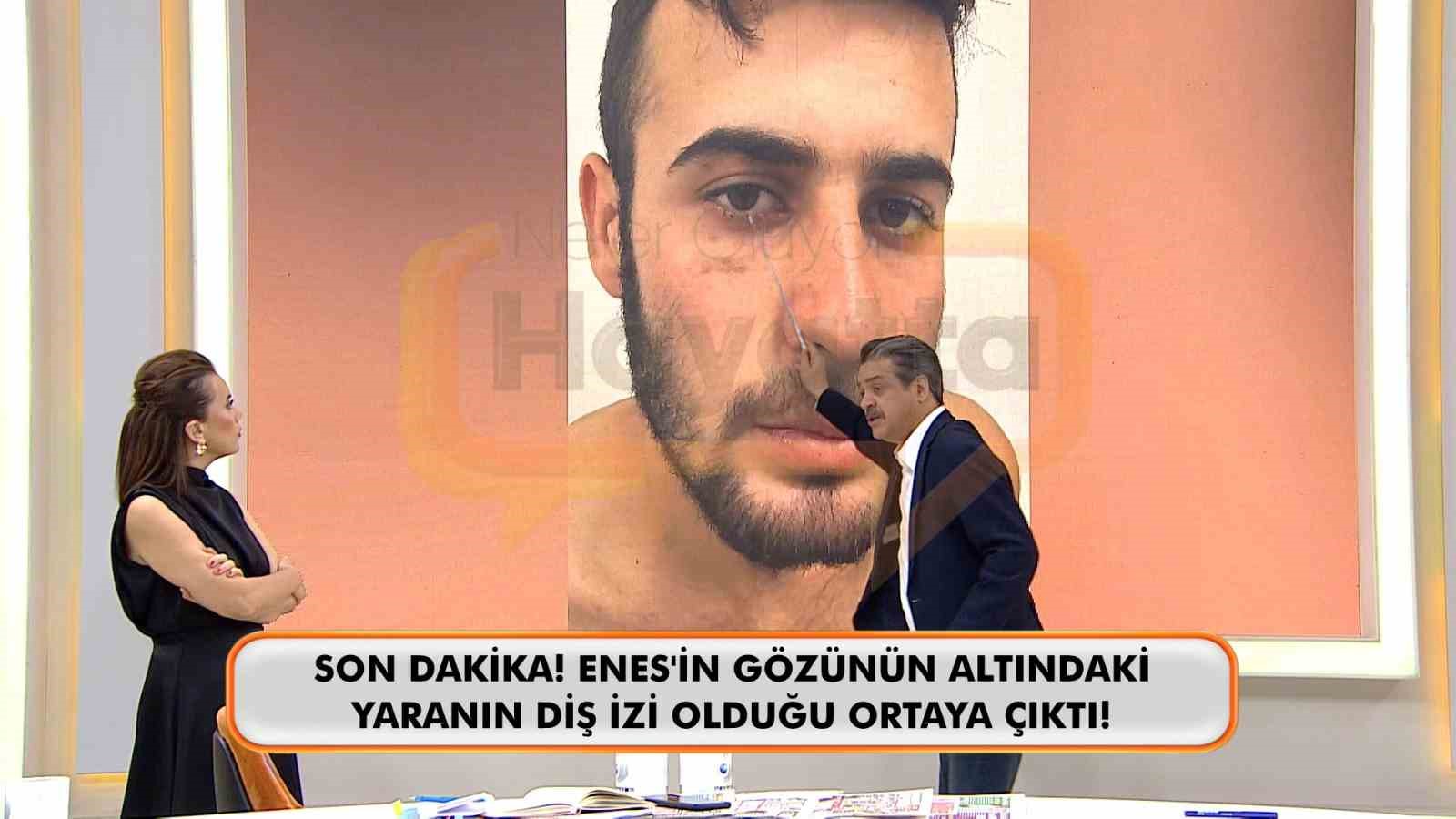 Canlı yayında Enes G&uuml;ran&rsquo;ın g&ouml;z&uuml;n&uuml;n altındaki diş izine dikkat &ccedil;ekildi
