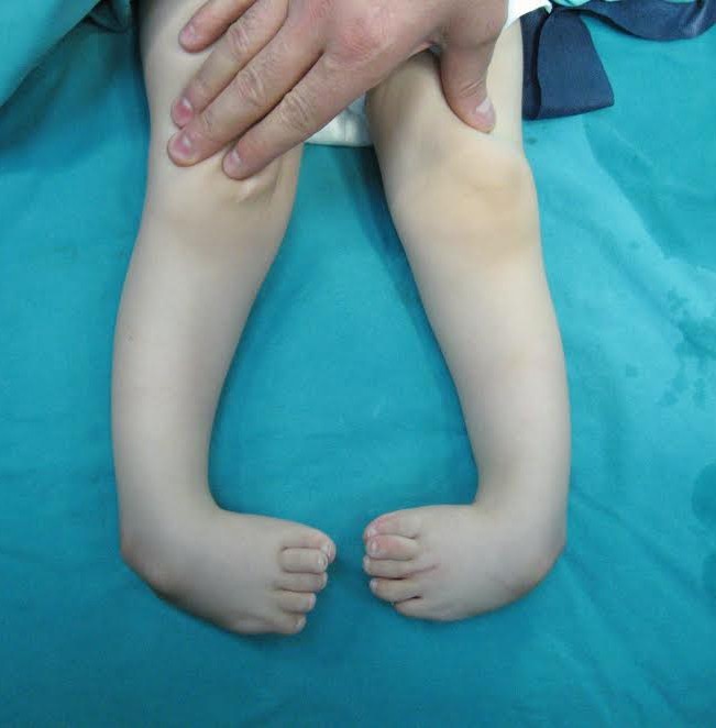 &Ccedil;arpık ayak hastalığında erken teşhis tedaviyi hızlandırıyor
