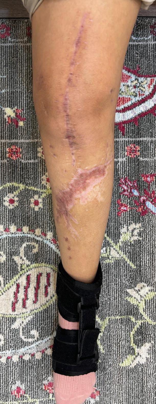 Susurluk&rsquo;ta trafik kazası: Bir ailenin hayatı karardı, adalet beklentisi s&uuml;r&uuml;yor
