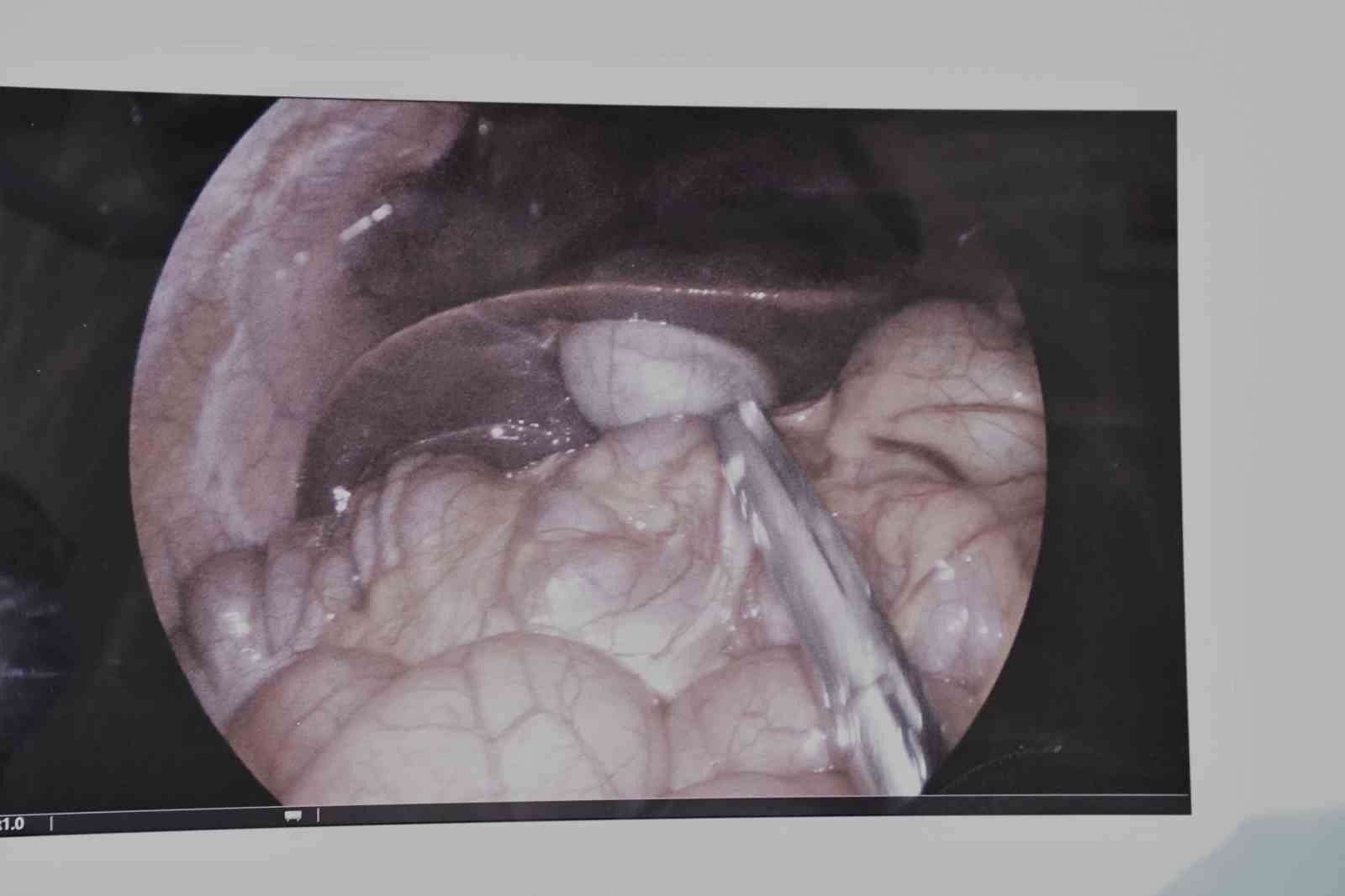 Yozgat Şehir Hastanesi’nde kritik ameliyat başarıyla geçti