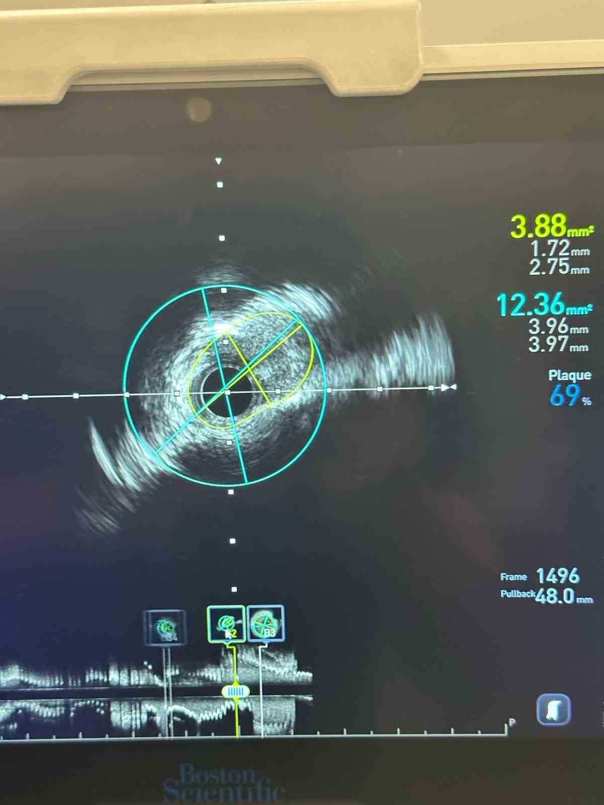 Yalova Eğitim ve Araştırma&rsquo;da ilk ileri kardiyovask&uuml;ler girişimlerde başarı
