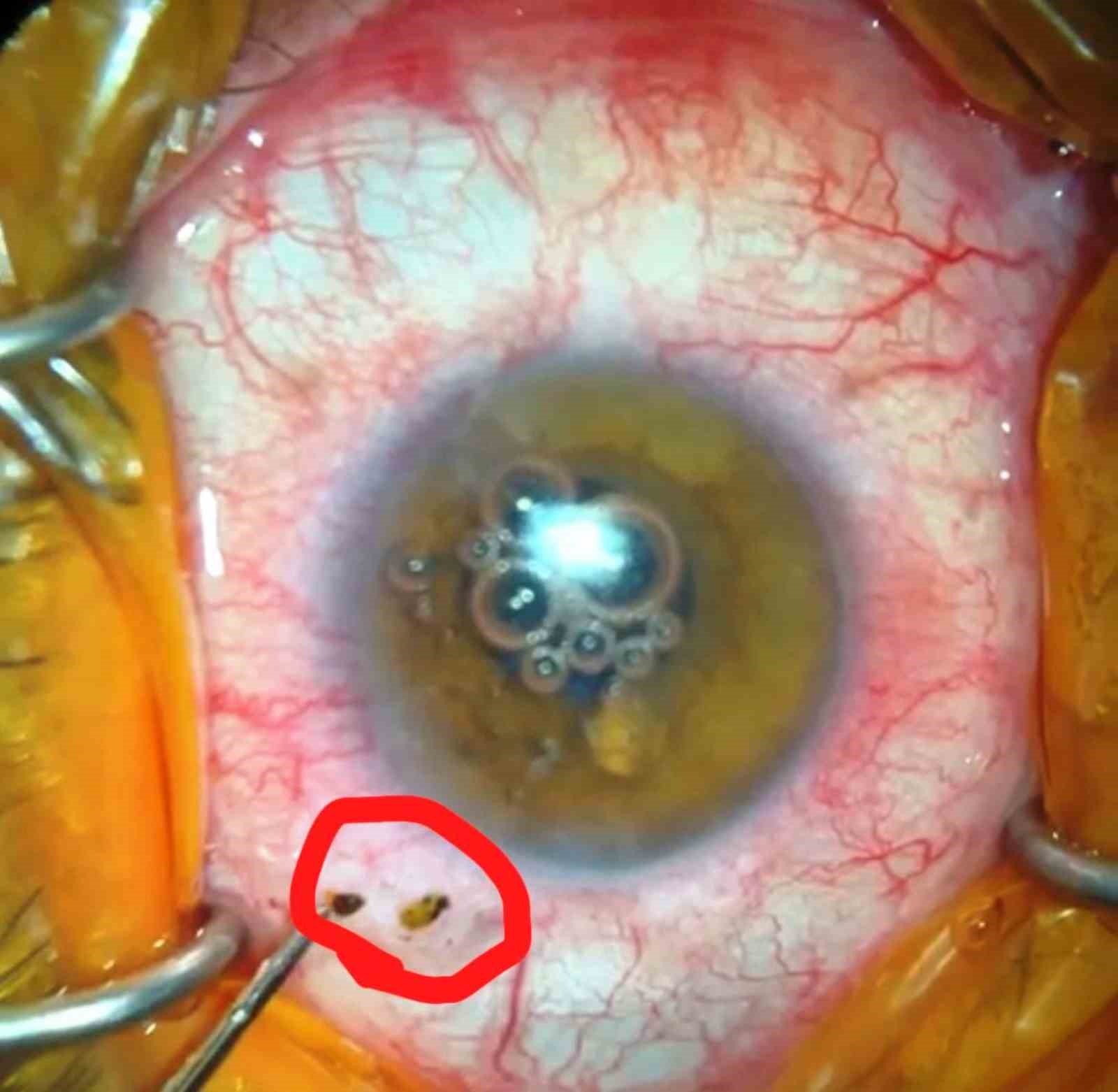 7 yıldır gözünde metal parçasıyla dolaşan adam sağlığına kavuştu