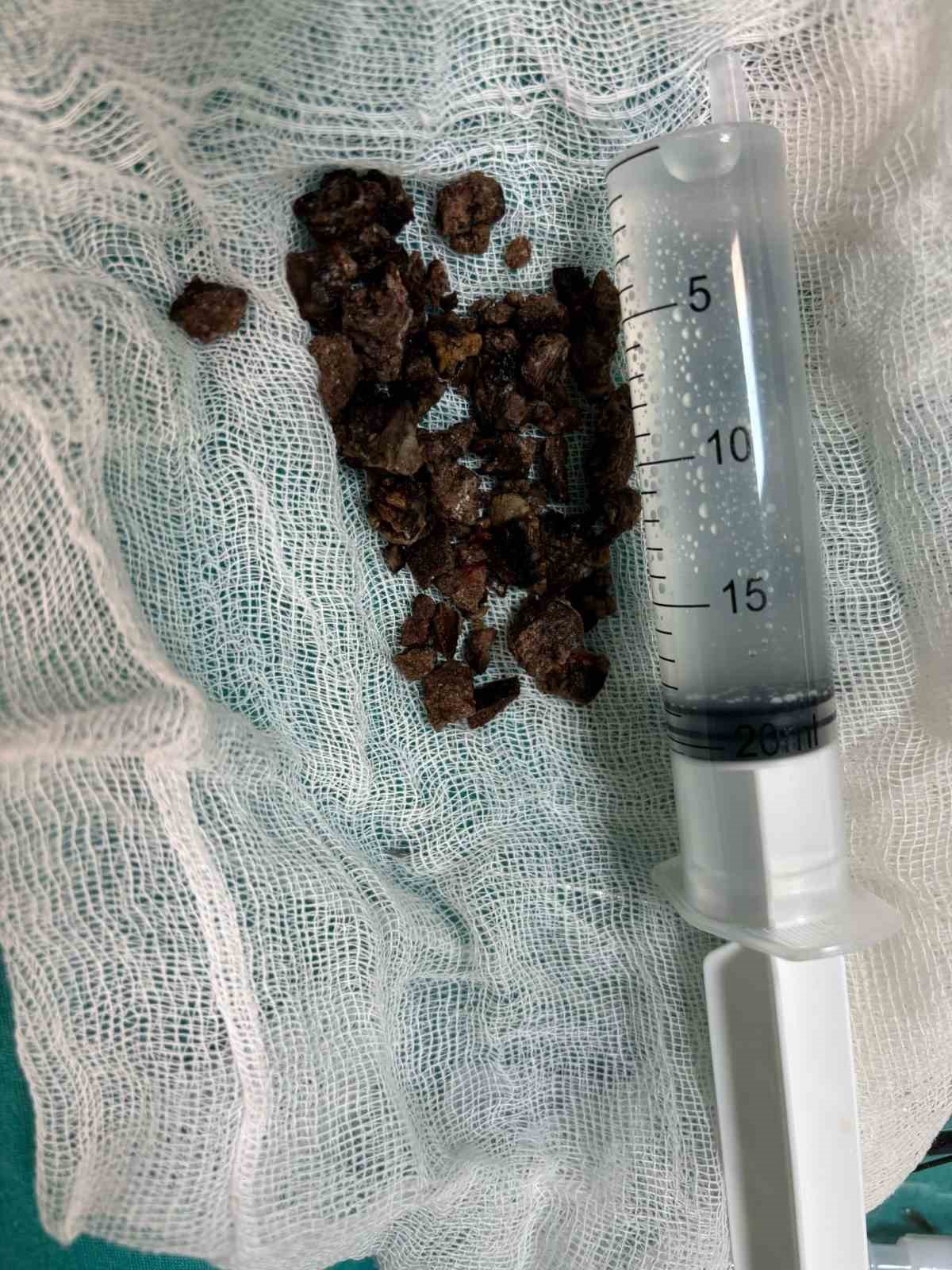 Kırşehir&rsquo;de bir kişinin b&ouml;breğinden 6 santim b&uuml;y&uuml;kl&uuml;ğ&uuml;nde taş &ccedil;ıkartıldı
