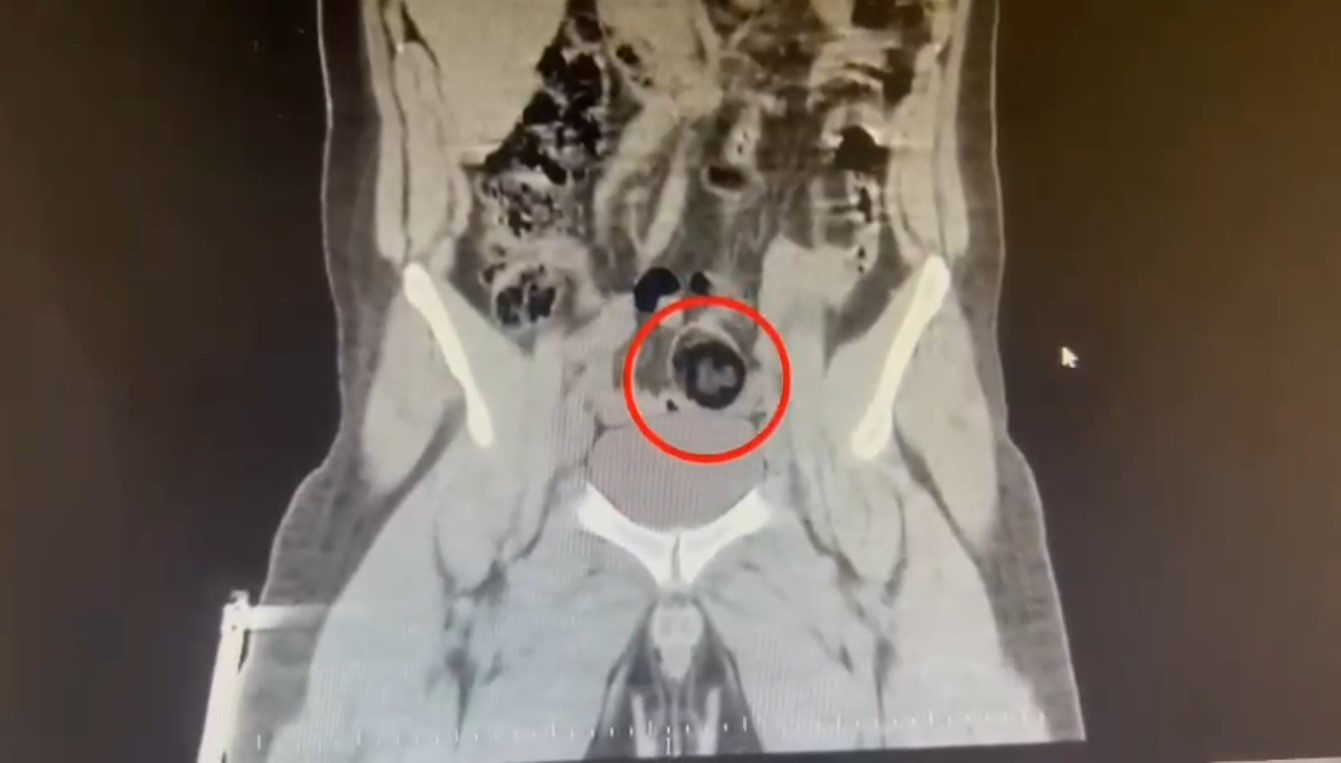 Kars’ta İranlı kuryenin makatından uyuşturucu çıktı