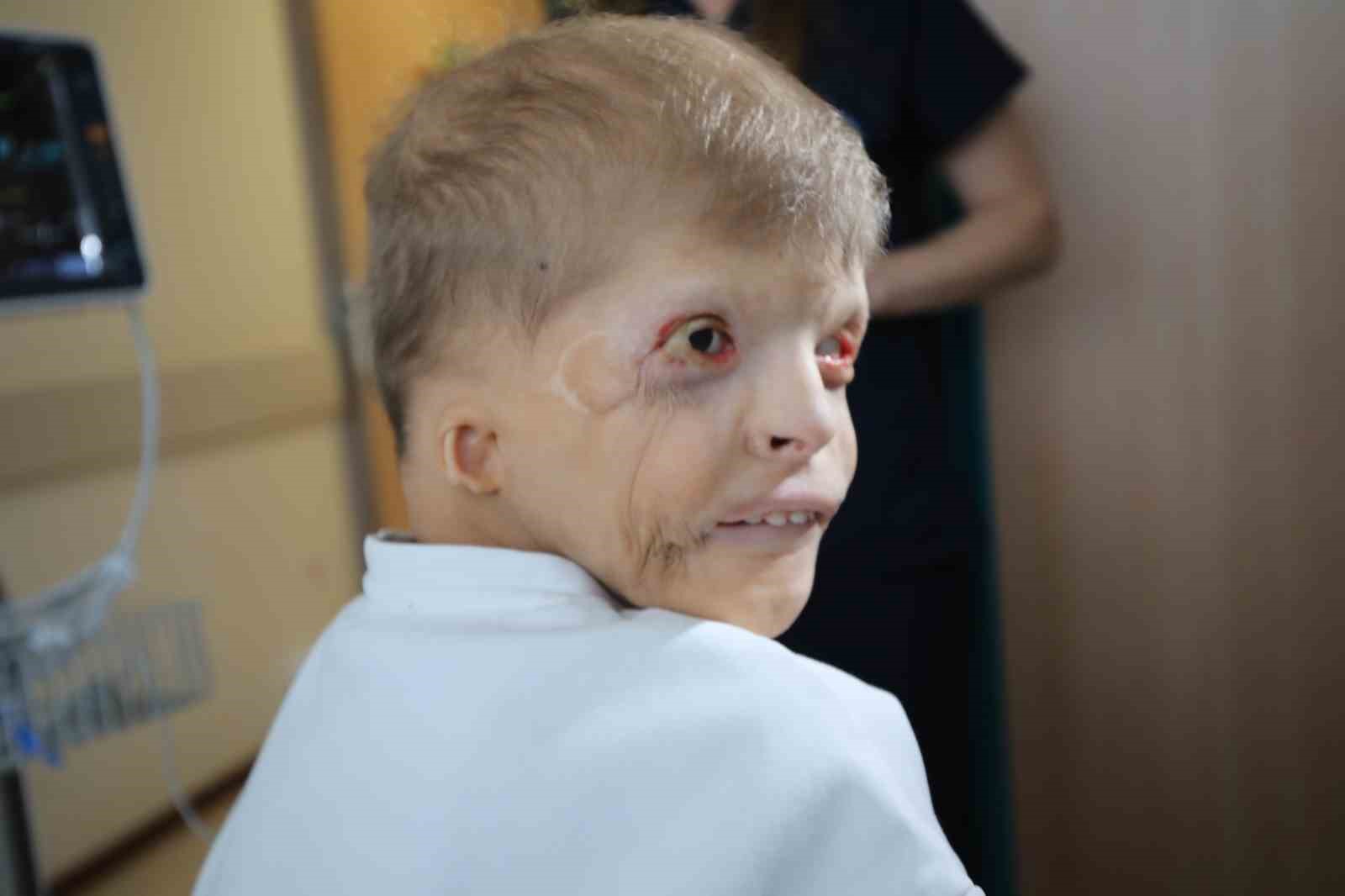 Ukraynalı Myhailo’nun kulak kepçeleri, Antalya’da kaburgalarından yapılacak