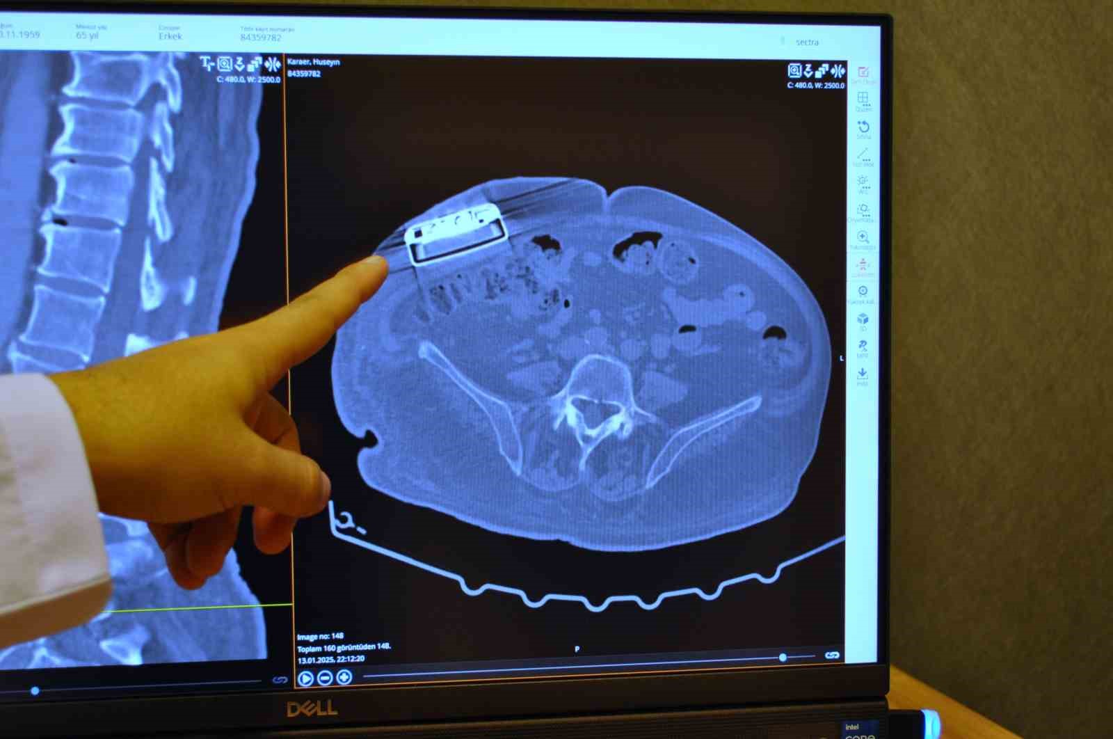 (ÖZEL) Gelişmiş teknoloji yeni versiyon baklofen pompası Türkiye’de ilk defa Eskişehir’de implante edildi