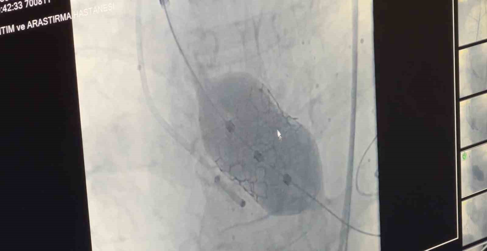 D&uuml;nyada 18&rsquo;nci, T&uuml;rkiye&rsquo;de ilk: 4 yaprak&ccedil;ıklı aort kapağına TAVİ operasyonu
