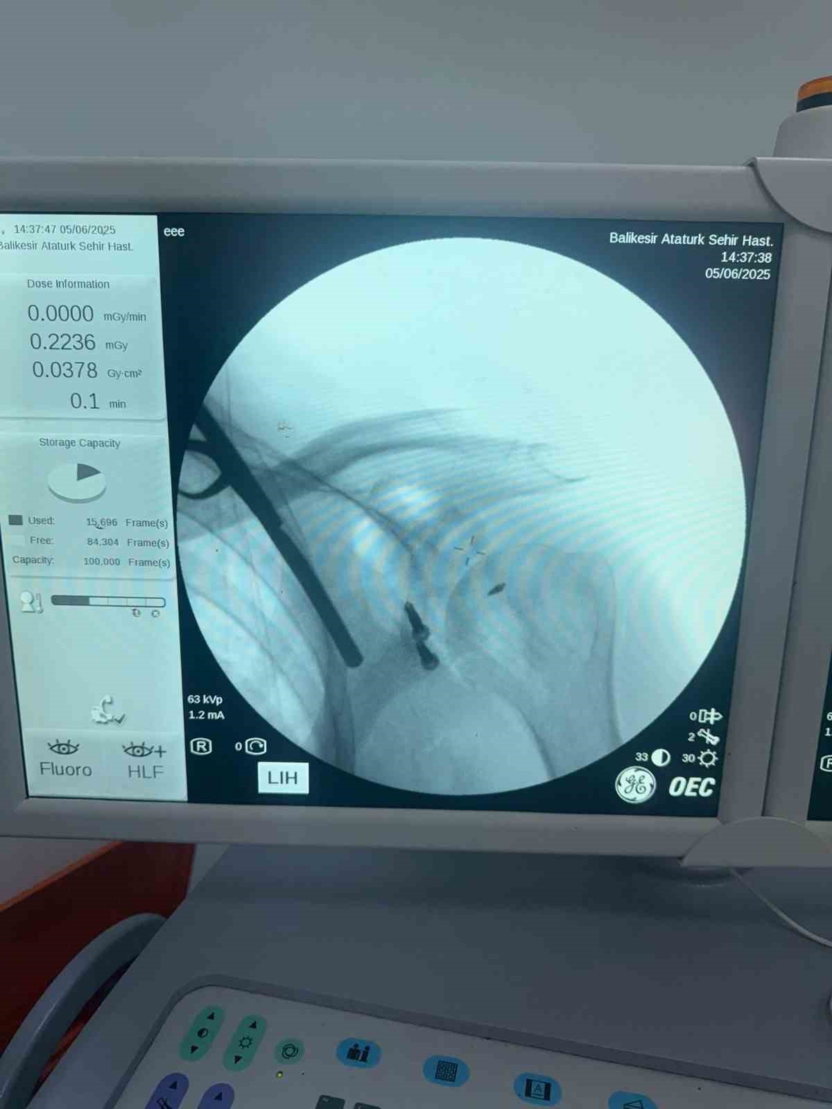 Balıkesir&rsquo;de ilk defa latarjet omuz ameliyatı ger&ccedil;ekleştirildi
