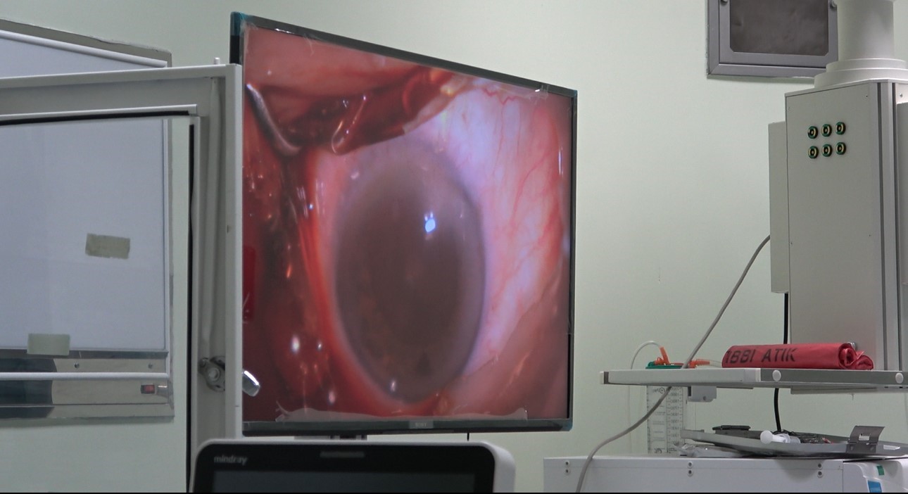 Ağrı&rsquo;da bir ilk: 78 yaşındaki hastaya "akıllı mercek" ameliyatı başarıyla uygulandı
