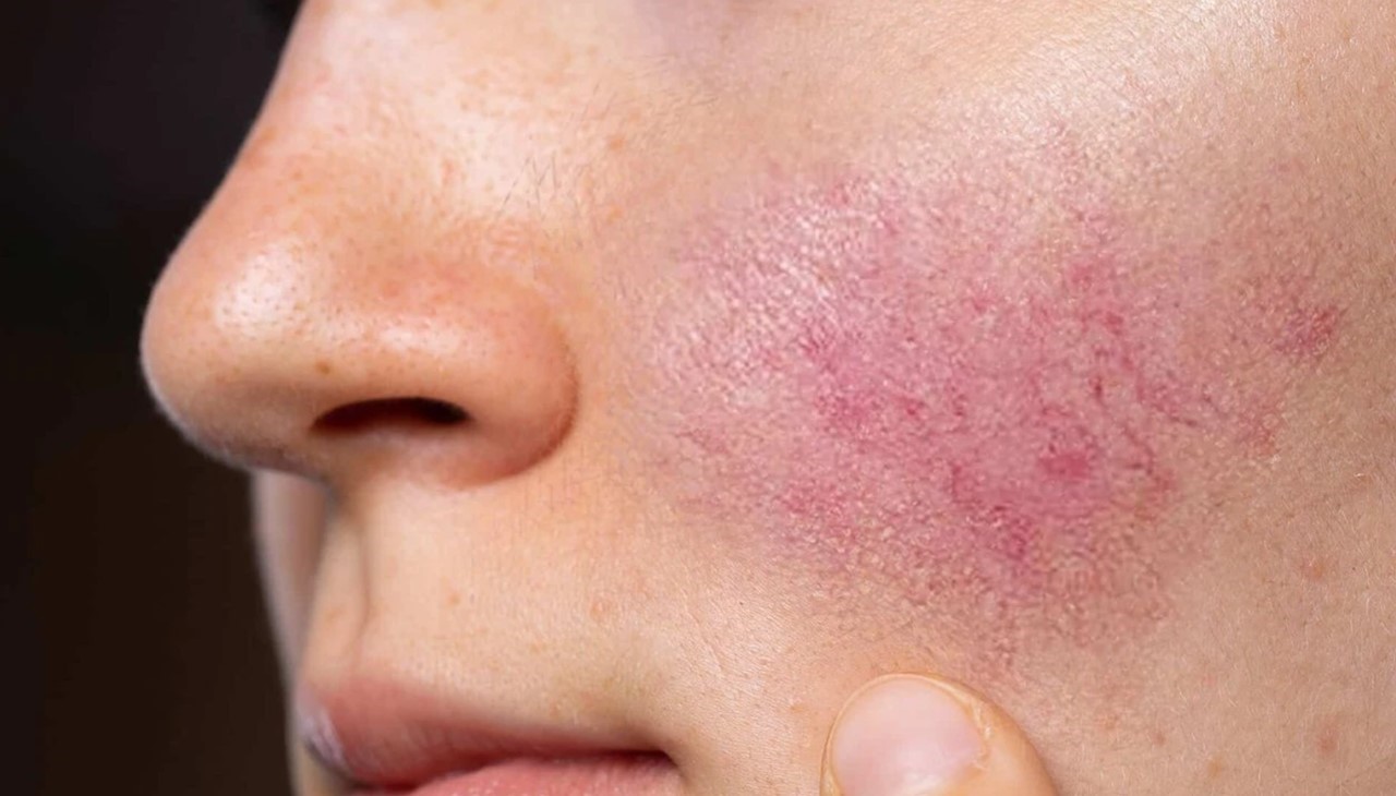 Gül hastalığı ihmal edilmemeli