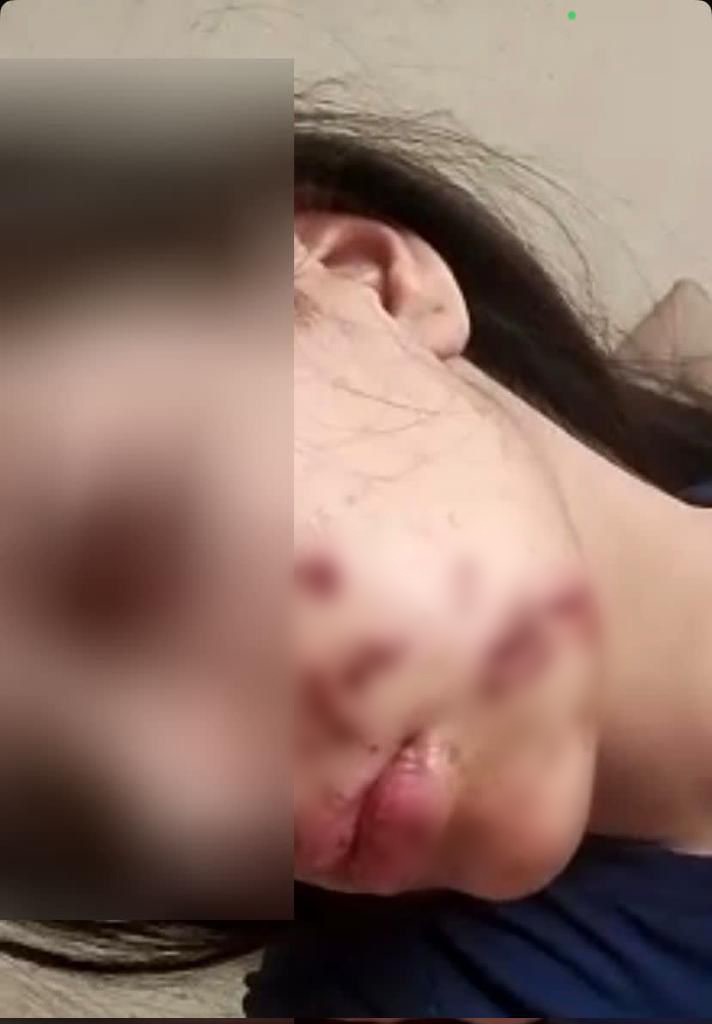 Yüzüne maytap isabet eden genç kız yaralandı