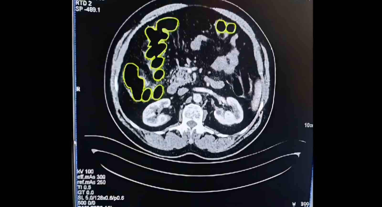 Mide ve bağırsaklarından uyuşturucu &ccedil;ıktı
