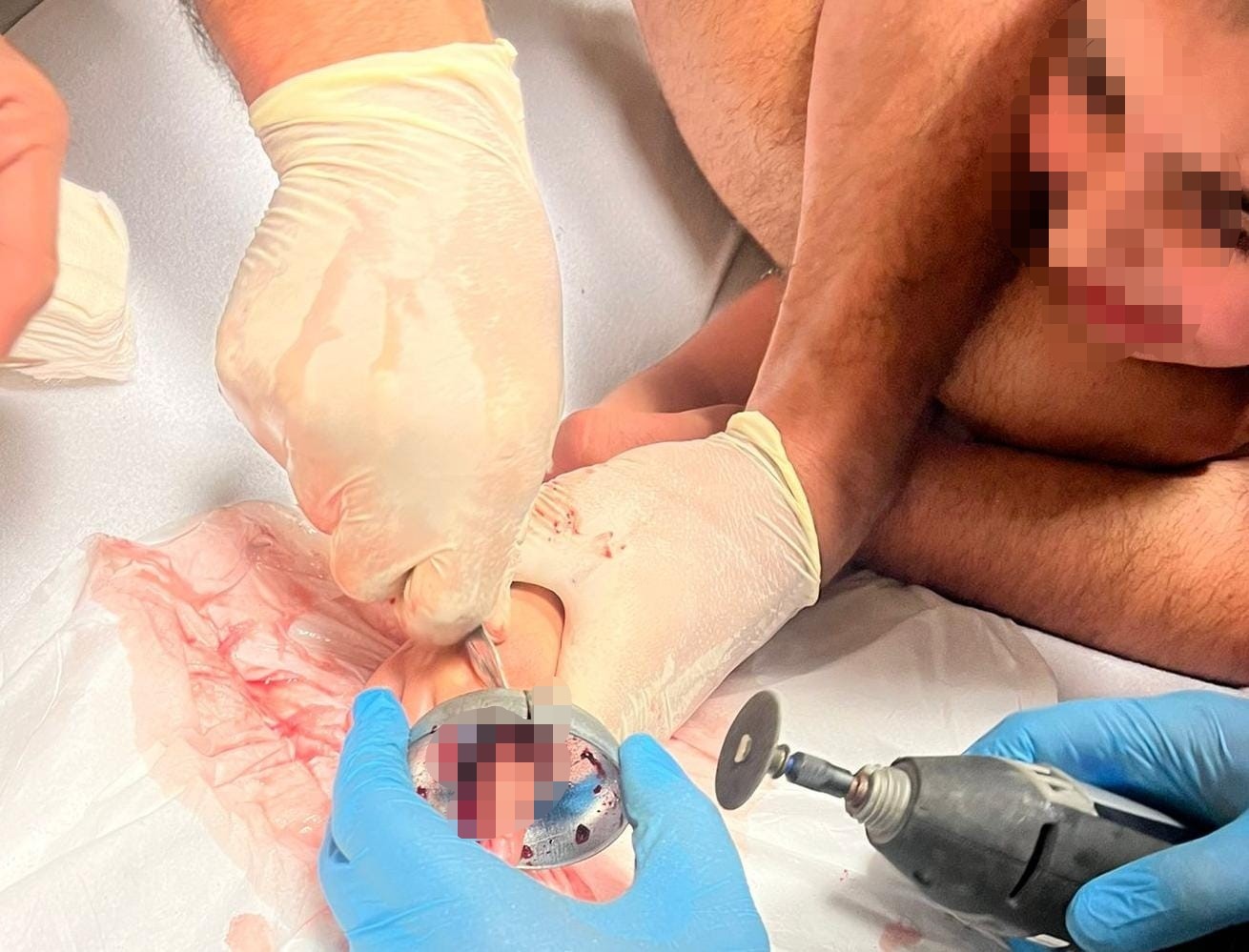 Bursa’da çocuğun parmağı çeşme aynasına sıkıştı