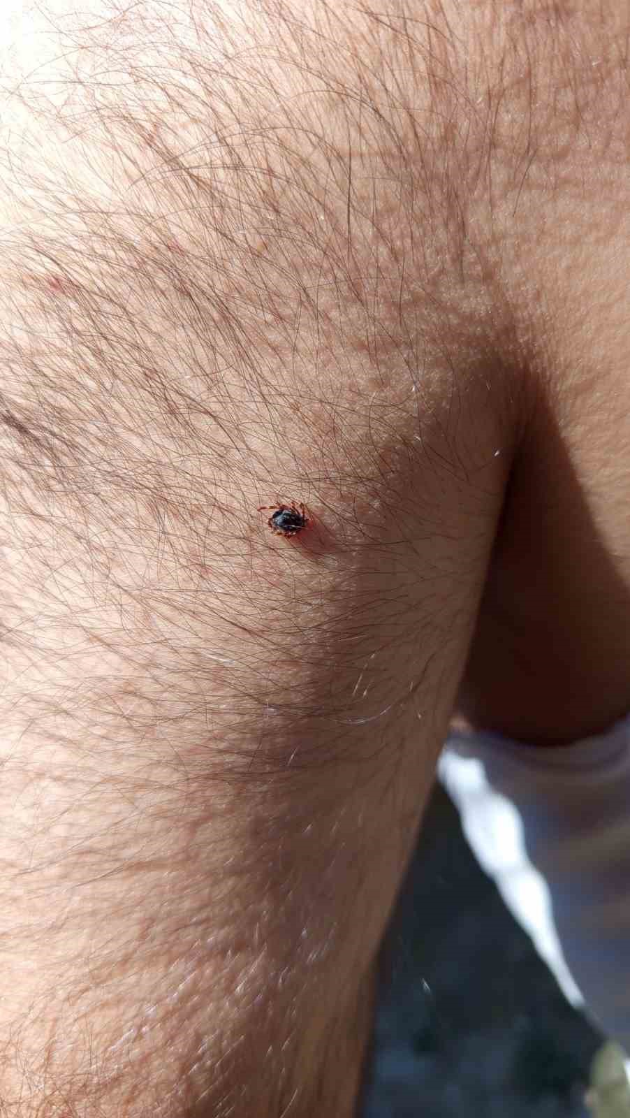 Kayseri&rsquo;nin bir il&ccedil;esinde daha kene vakası
