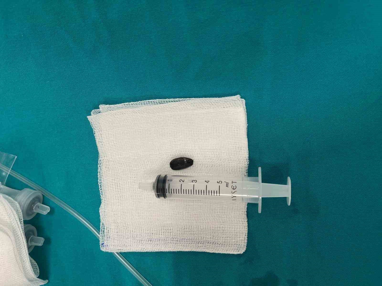 &Ccedil;ekirdek kabukları yutması sonucu nefessiz kalan bebek yapılan ameliyatla kurtarıldı
