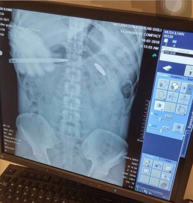 15 Temmuz&rsquo;da hainlere direnirken vurulan Musa İlhan: "9 yıldır g&ouml;ğs&uuml;mde gaziliğin nişanesini taşıyorum"
