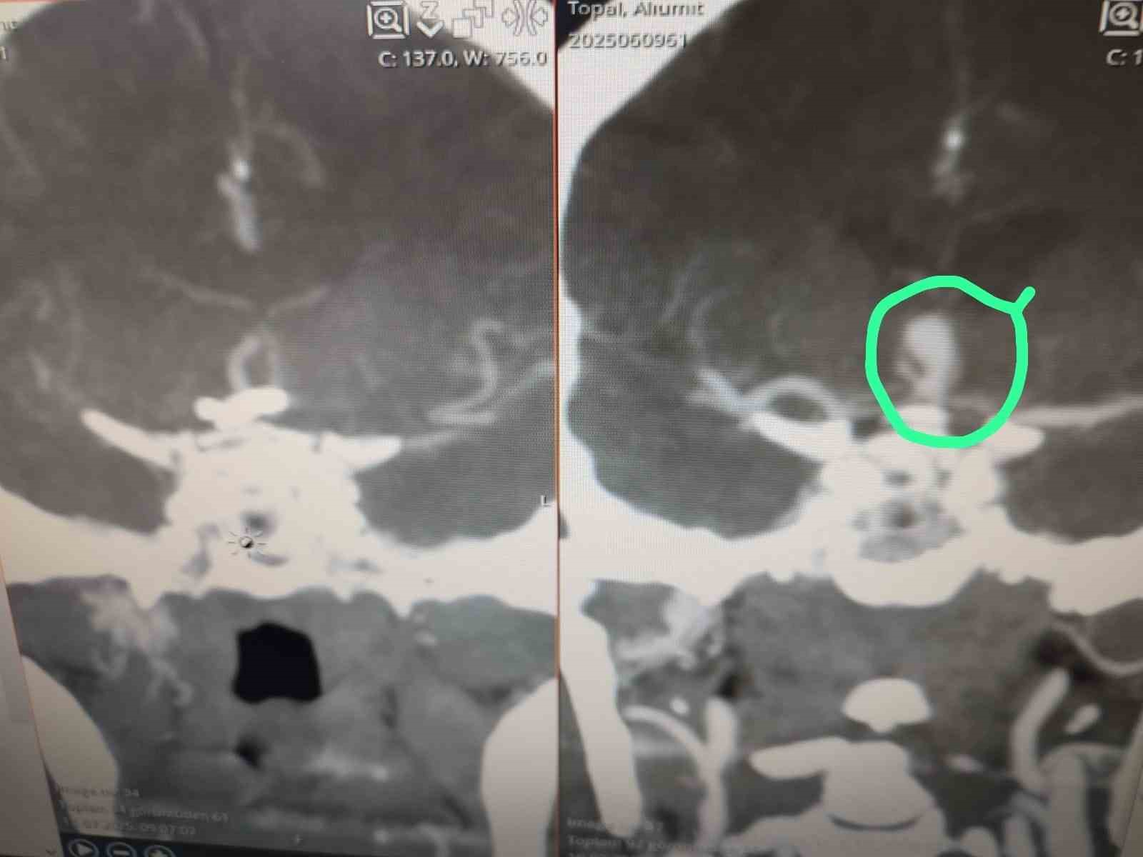 Anevrizma ameliyatında estetik ve konfor