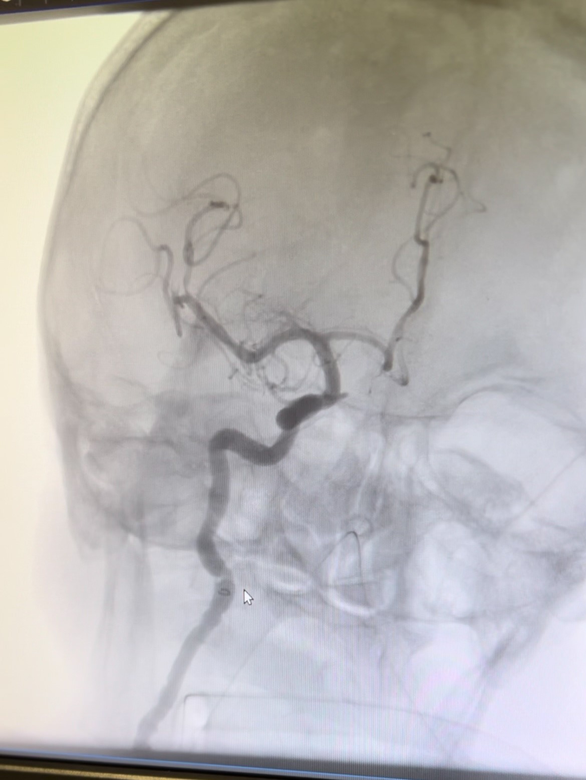 İnme inen hasta şifayı Manisa Şehir Hastanesinde buldu
