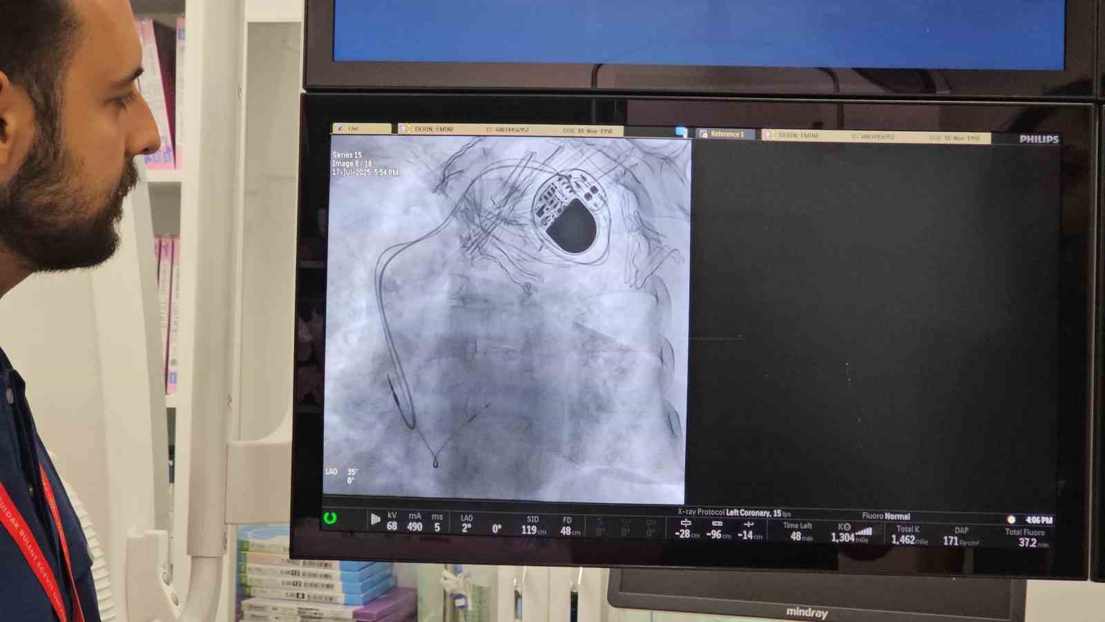 BEUN’da ritim bozuklukları için yeni tedavi yöntemi uygulanmaya başlandı