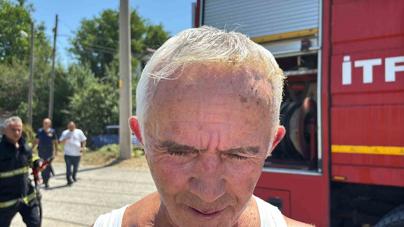 Çöpleri yakmak isterken kendini de yaktı