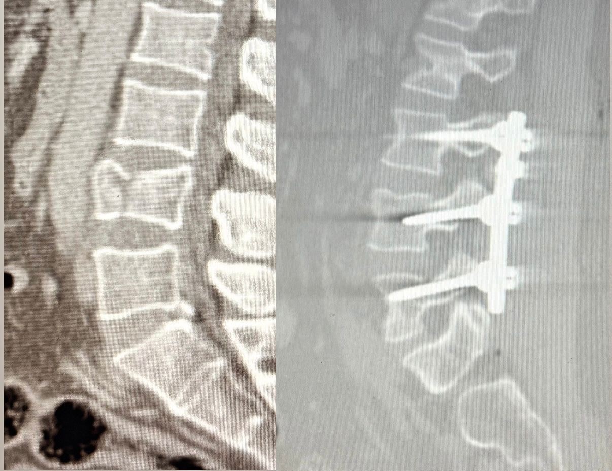 Yüksekten düşen hasta, Patnos’ta ilk kez uygulanan ameliyatla ayağa kalktı