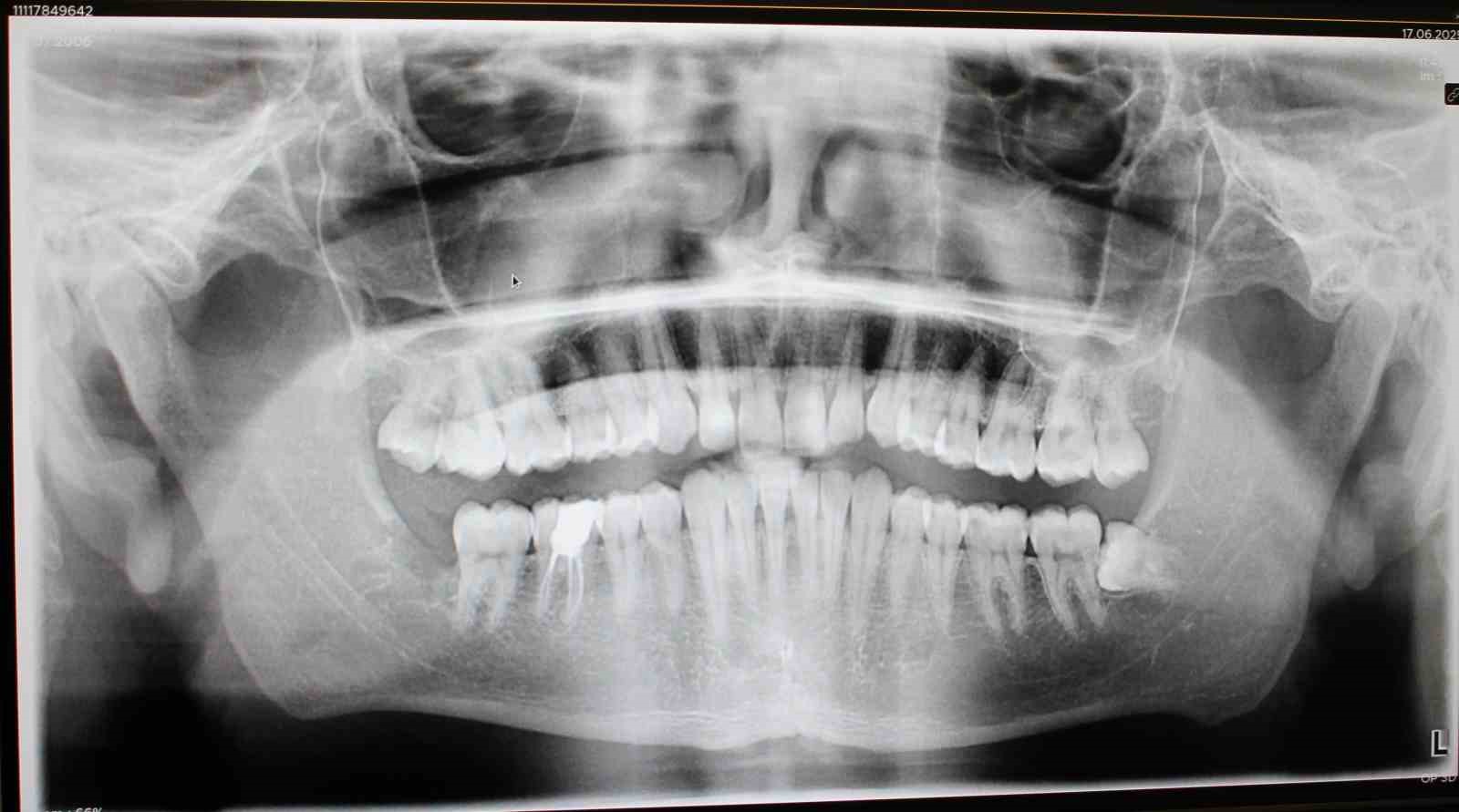 Midyat Ağız ve Diş Sağlığı Merkezi&rsquo;nde 20 yaş dişleri cerrahi operasyonla alınıyor
