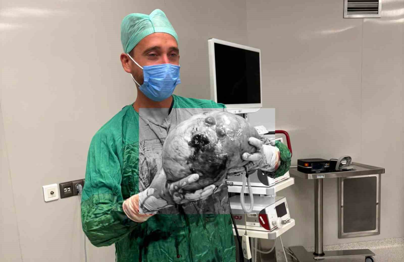 Yozgat’ta bir hastadan karpuz büyüklüğünde kitle çıkartıldı