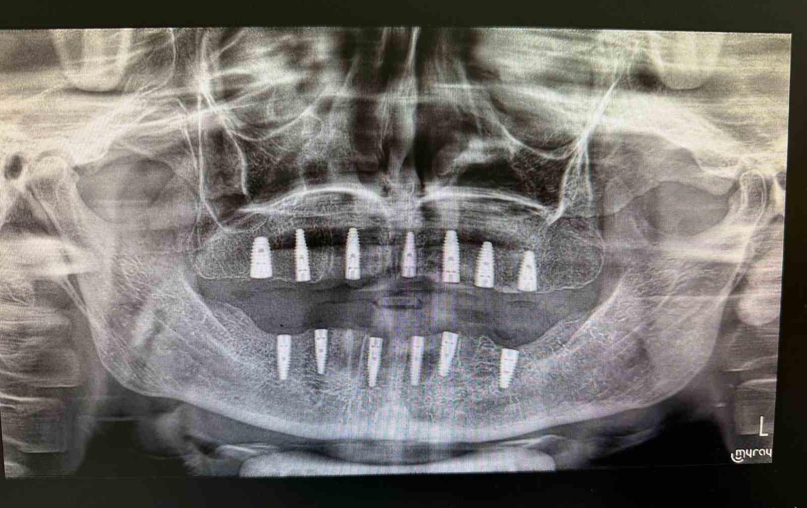 Bayburt’ta hiç dişi olmayan hasta implant tedavisiyle yeni dişlerine kavuştu