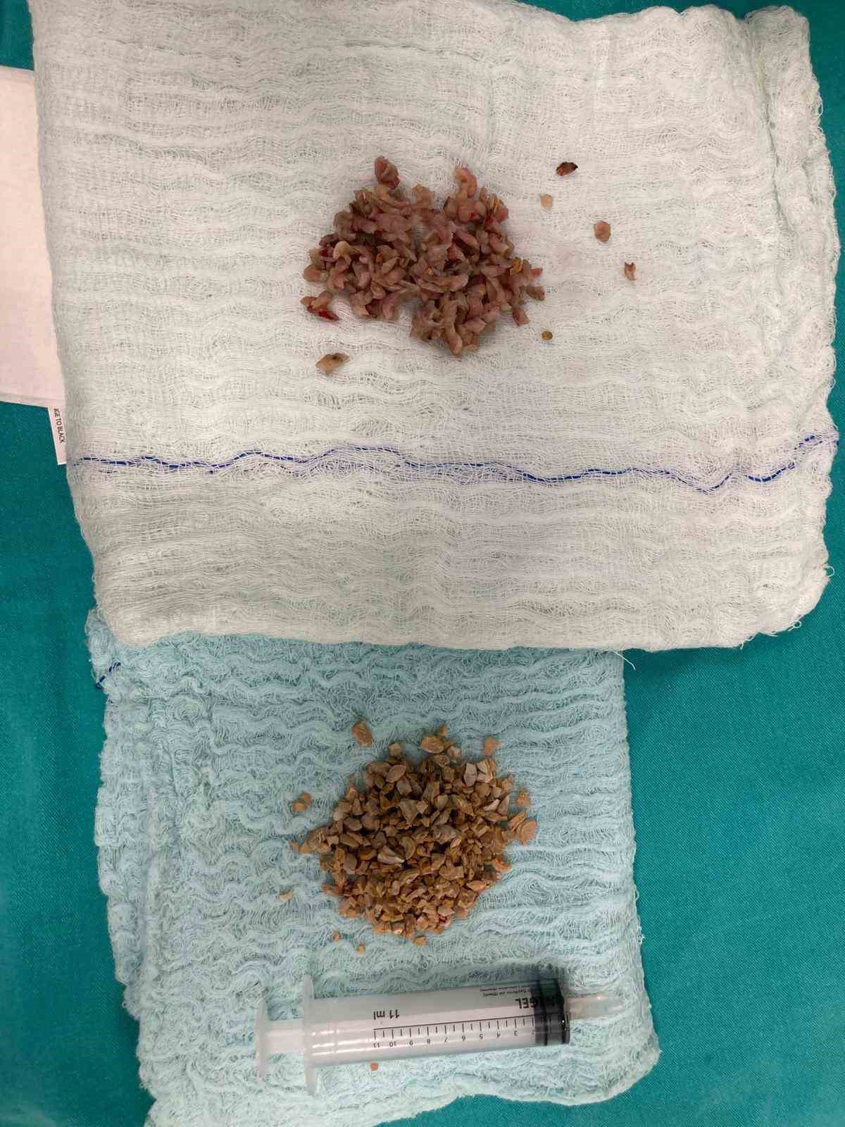 Bayburt’ta 84 yaşındaki hastanın mesane taşları kapalı yöntemle çıkarıldı