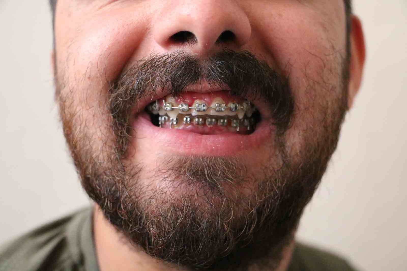 5 yaşındayken geçirdiği havale sonucu çene yapısı bozuldu, 21 yıldır sağlığına kavuşmanın hayaliyle yaşıyor